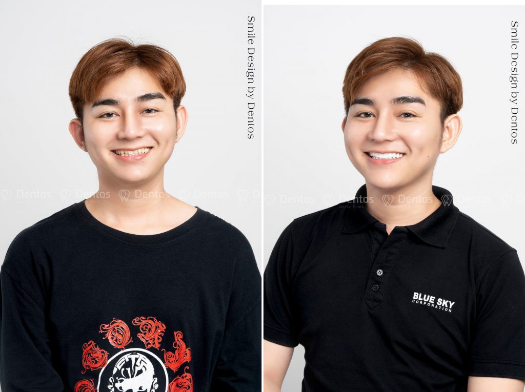 Khách hàng Long Phi đã tin tưởng và chọn Nha Khoa Dentos